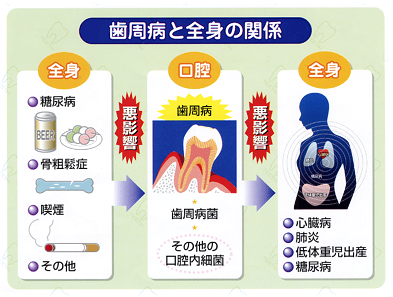 歯周病歯科検診